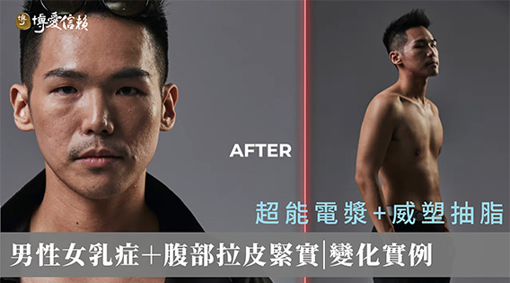重拾自信，重新走回泳池的那一天 — 男性女乳症＋腹部拉皮緊實（超能電漿＋威塑抽脂）｜博愛信賴