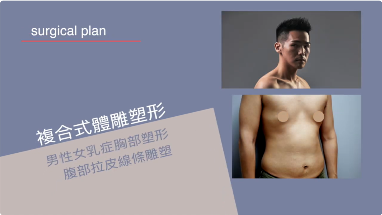 產後威塑抽脂、超能電漿與女王波複合式隆乳案例照片2
