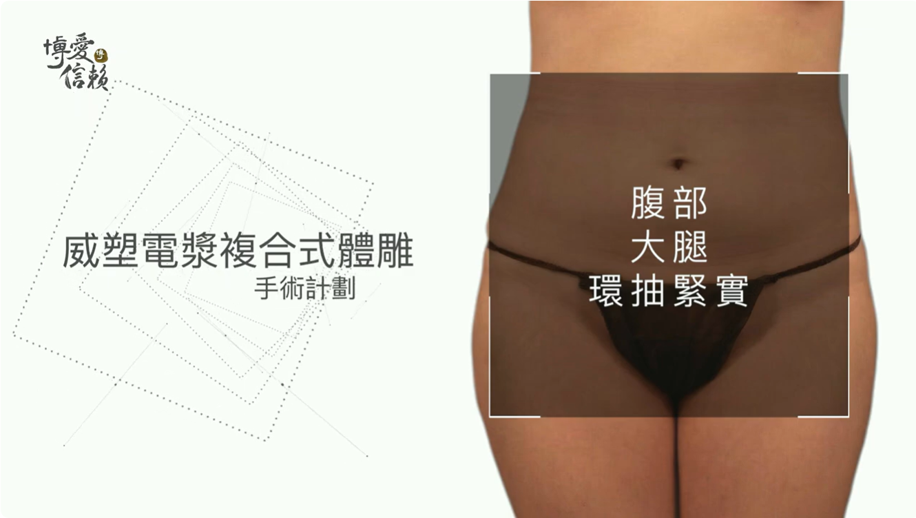 產後威塑抽脂、超能電漿與女王波複合式隆乳案例照片1