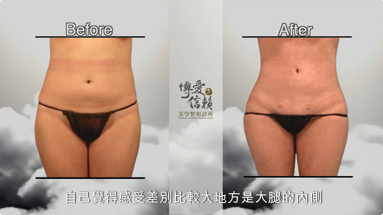 產後威塑抽脂、超能電漿與女王波複合式隆乳案例照片2
