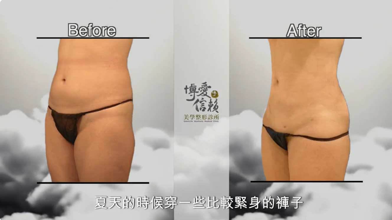 產後威塑抽脂、超能電漿與女王波複合式隆乳案例照片3