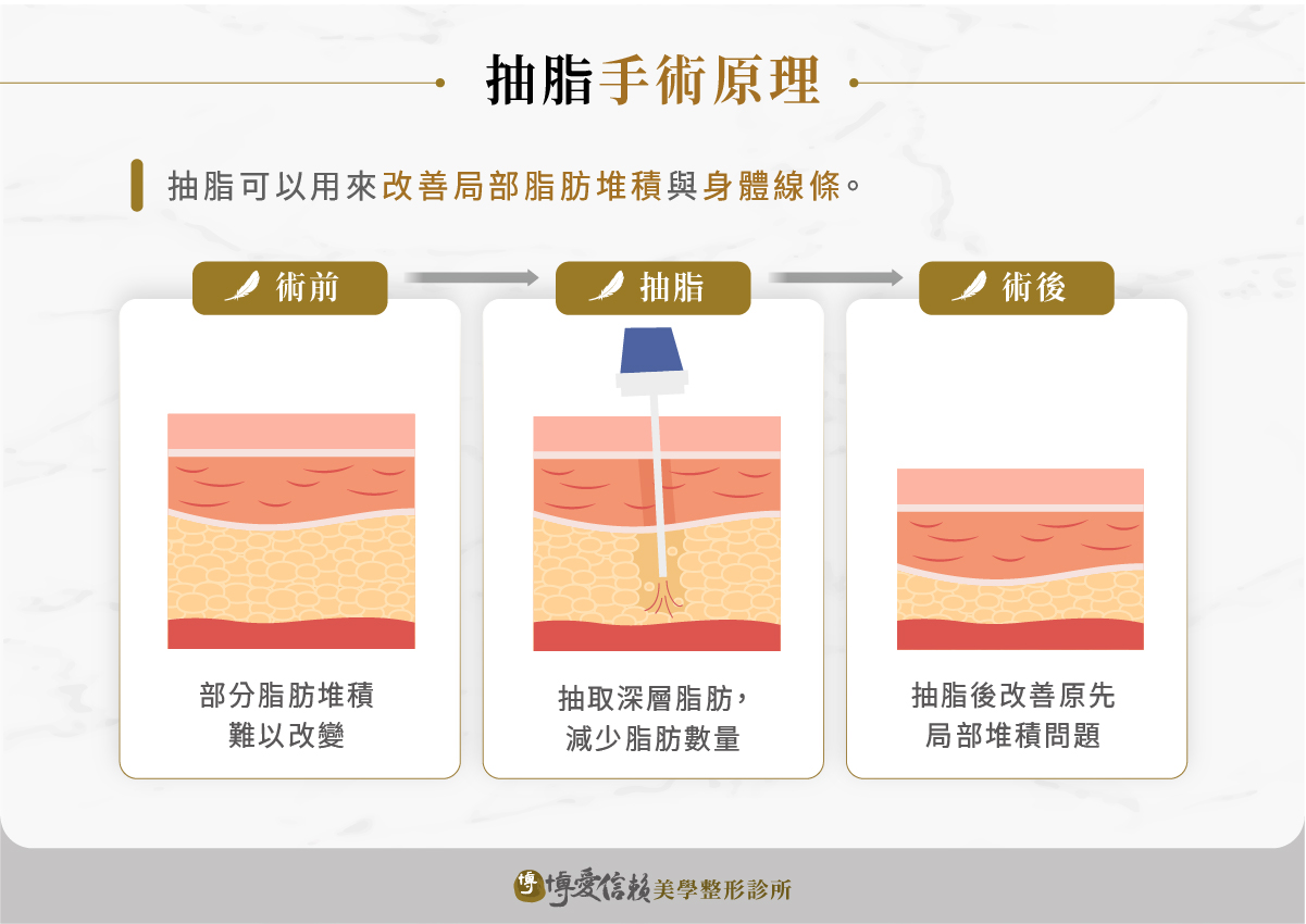 抽脂原理是利用負壓將多餘的脂肪吸出體外,減少皮下脂肪組織