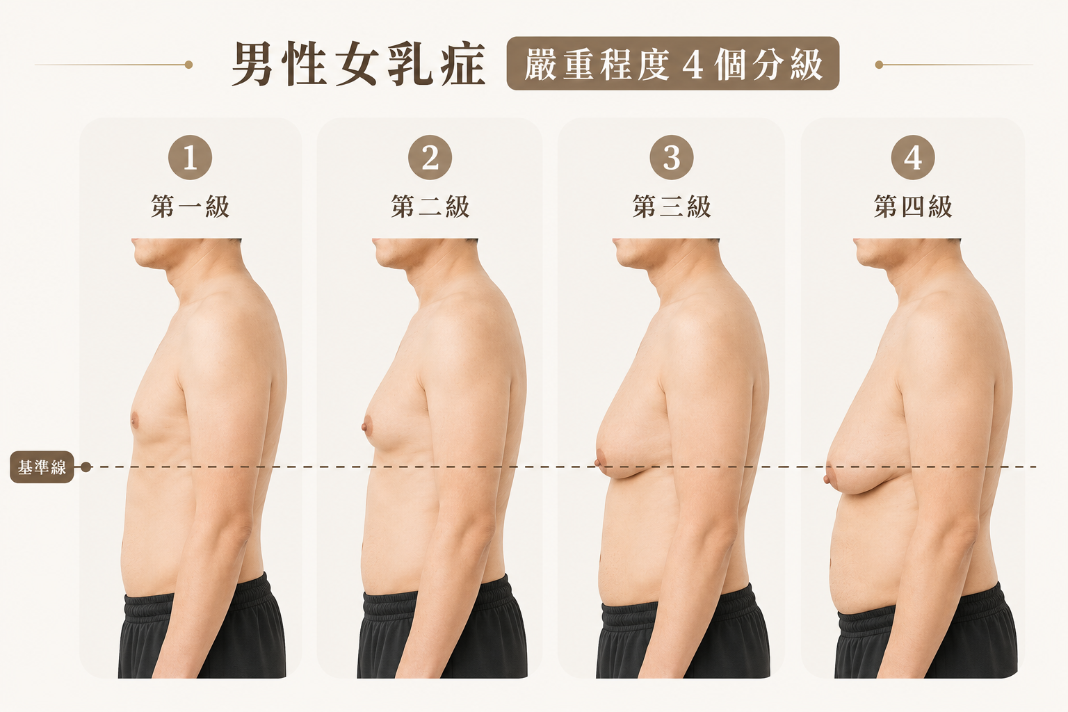 男性女乳症的 4 個嚴重程度分級