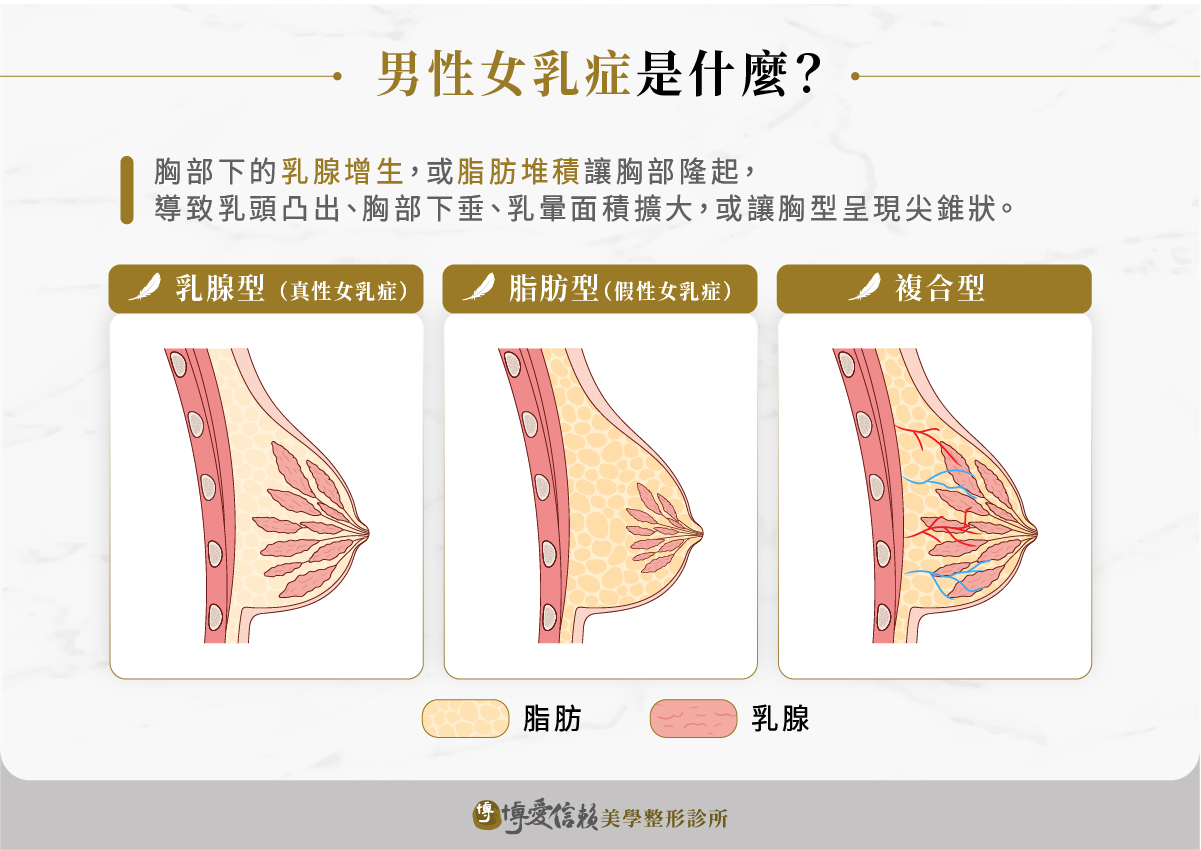 男性女乳症依照胸部隆起的組織成分,分成乳腺型、脂肪型與複合型三種