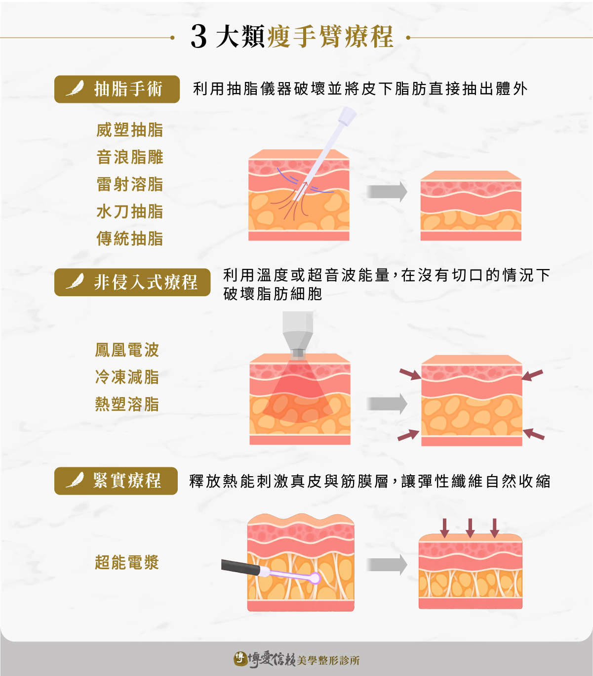 瘦手臂3大方式:抽脂手術、非侵入式療程、緊實療程