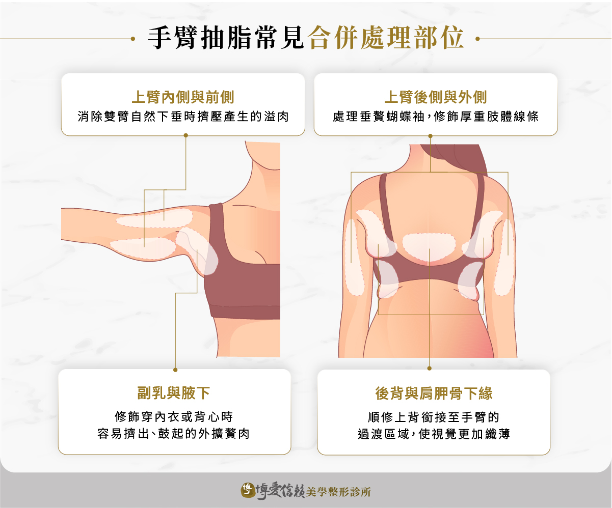 手臂抽脂常見合併處理部位:上臂後側與外側、上臂內側與前側、副乳與腋下、肩胛骨下緣與上背