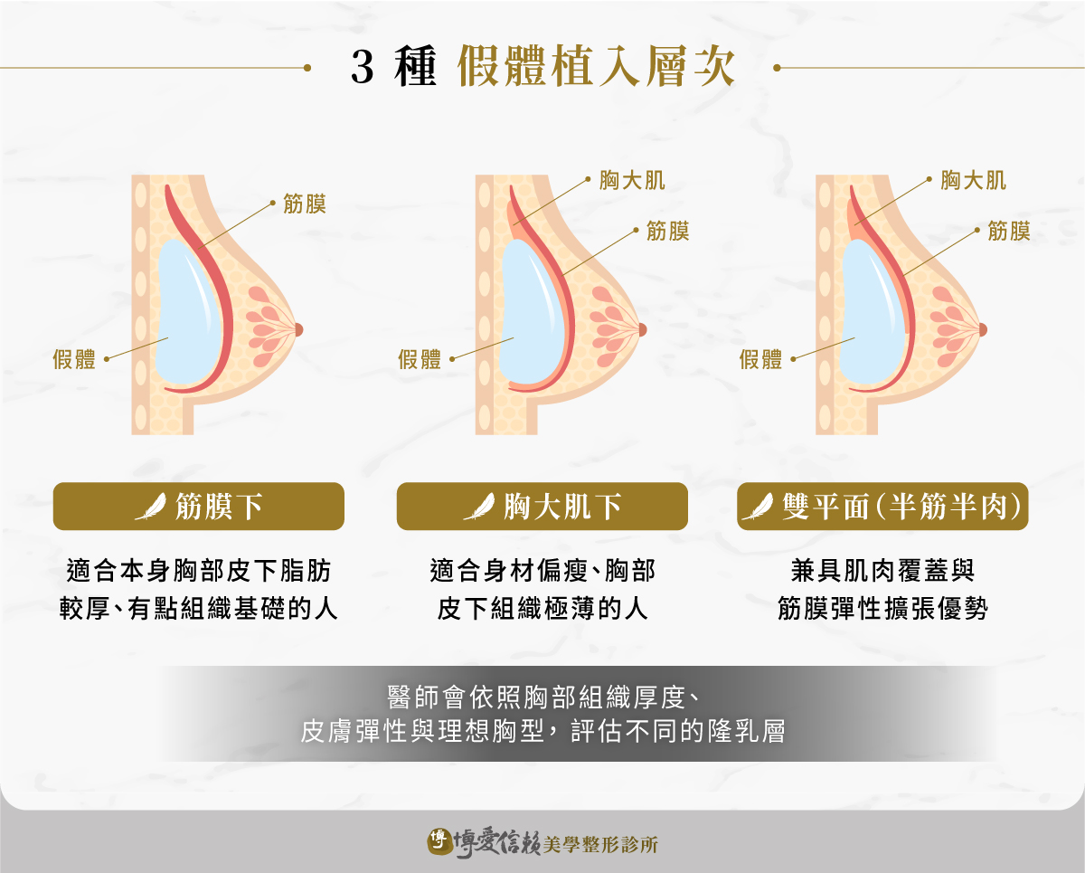 3 種假體植入層次差異:筋膜下、胸大肌下、雙平面