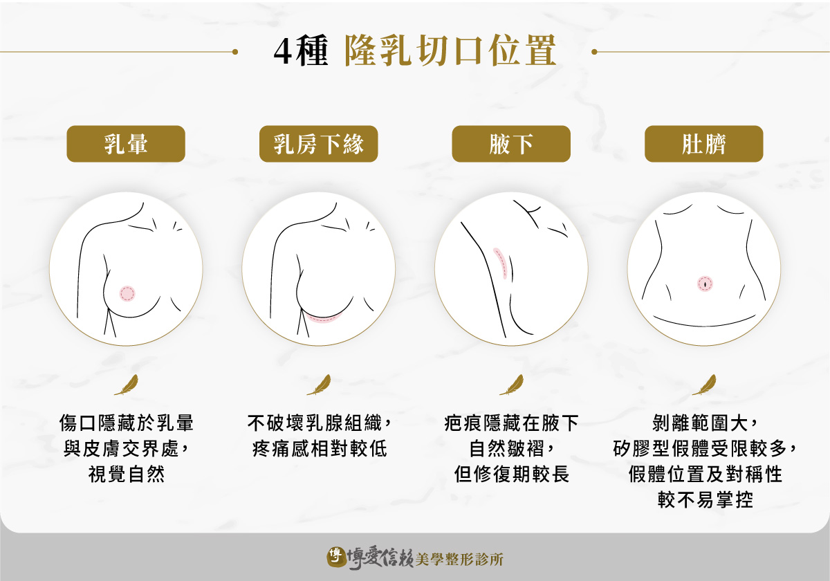 4 種隆乳切口位置:乳暈、乳房下緣、腋下、肚臍