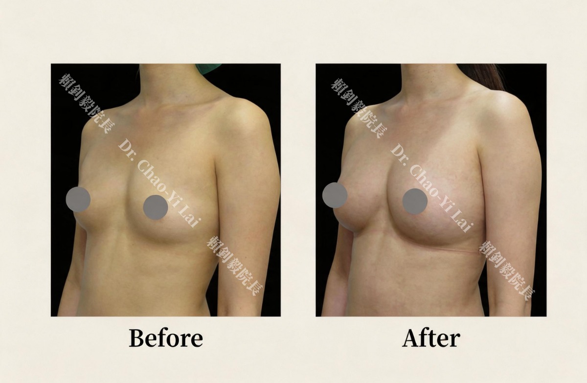 博愛信賴美學診所隆乳案例:自體脂肪隆乳改善上胸凹陷