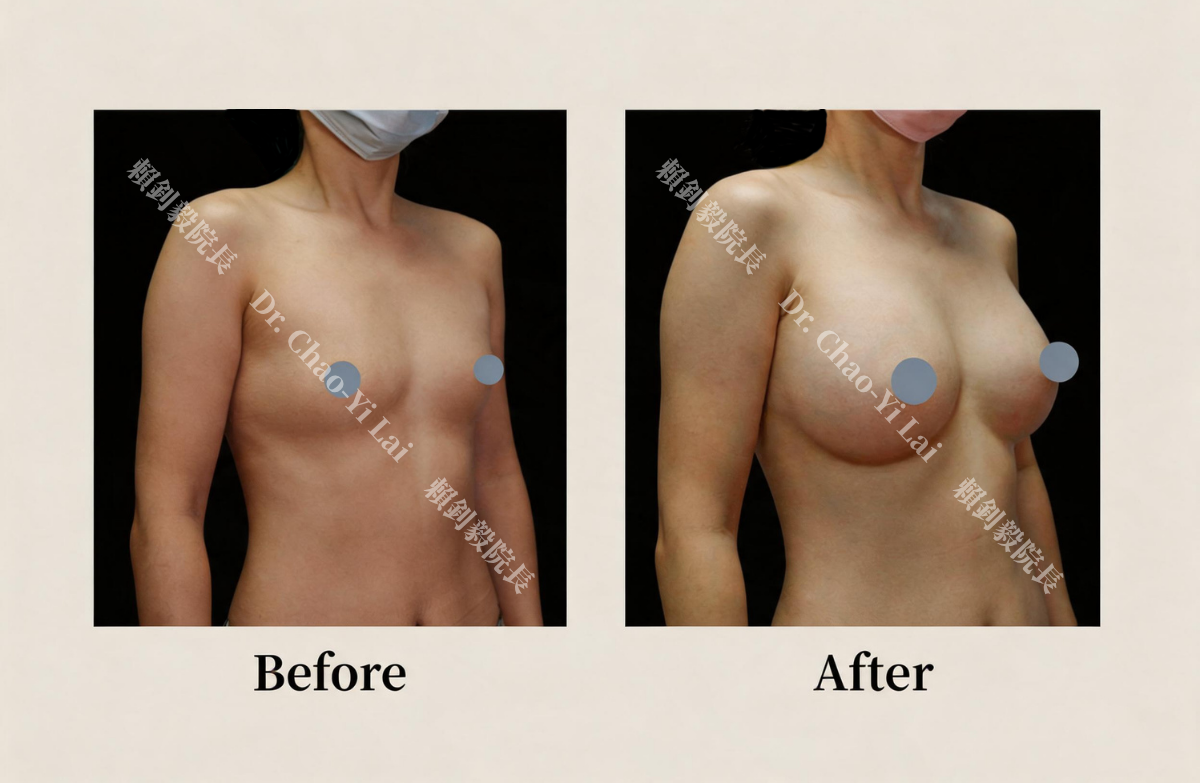 待替換圖片|檔名:Motiva Breast Augmentation Case at OmniLife Clinic: Post-Pregnancy Breast Reshaping.png 博愛信賴美學診所魔滴隆乳案例:產後調整胸型