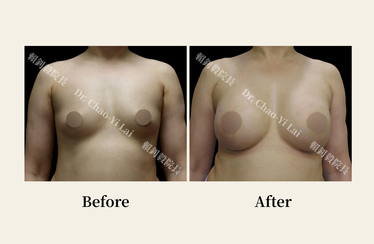 待替換圖片|檔名:Motiva Breast Augmentation Case at OmniLife Clinic: Refining a Wide Chest Wall.png 博愛信賴美學診所魔滴隆乳案例:修飾先天胸廓