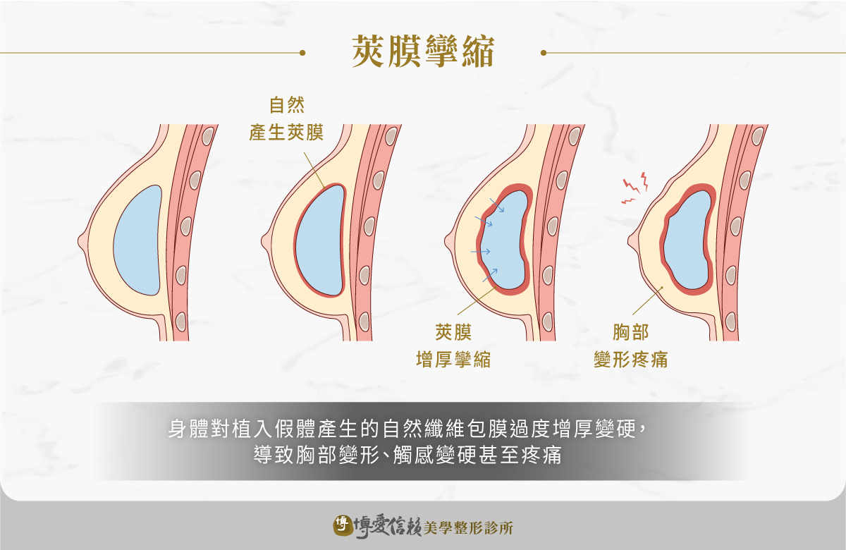 假體隆乳可能導致莢膜攣縮