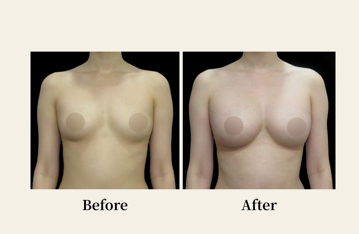 博愛信賴美學診所自體脂肪隆乳手術分享